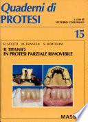 Il titanio in protesi parziale rimovibile