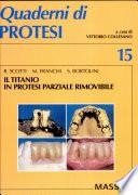 Il titanio in protesi parziale rimovibile