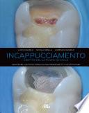 Incappucciamento diretto della polpa dentale